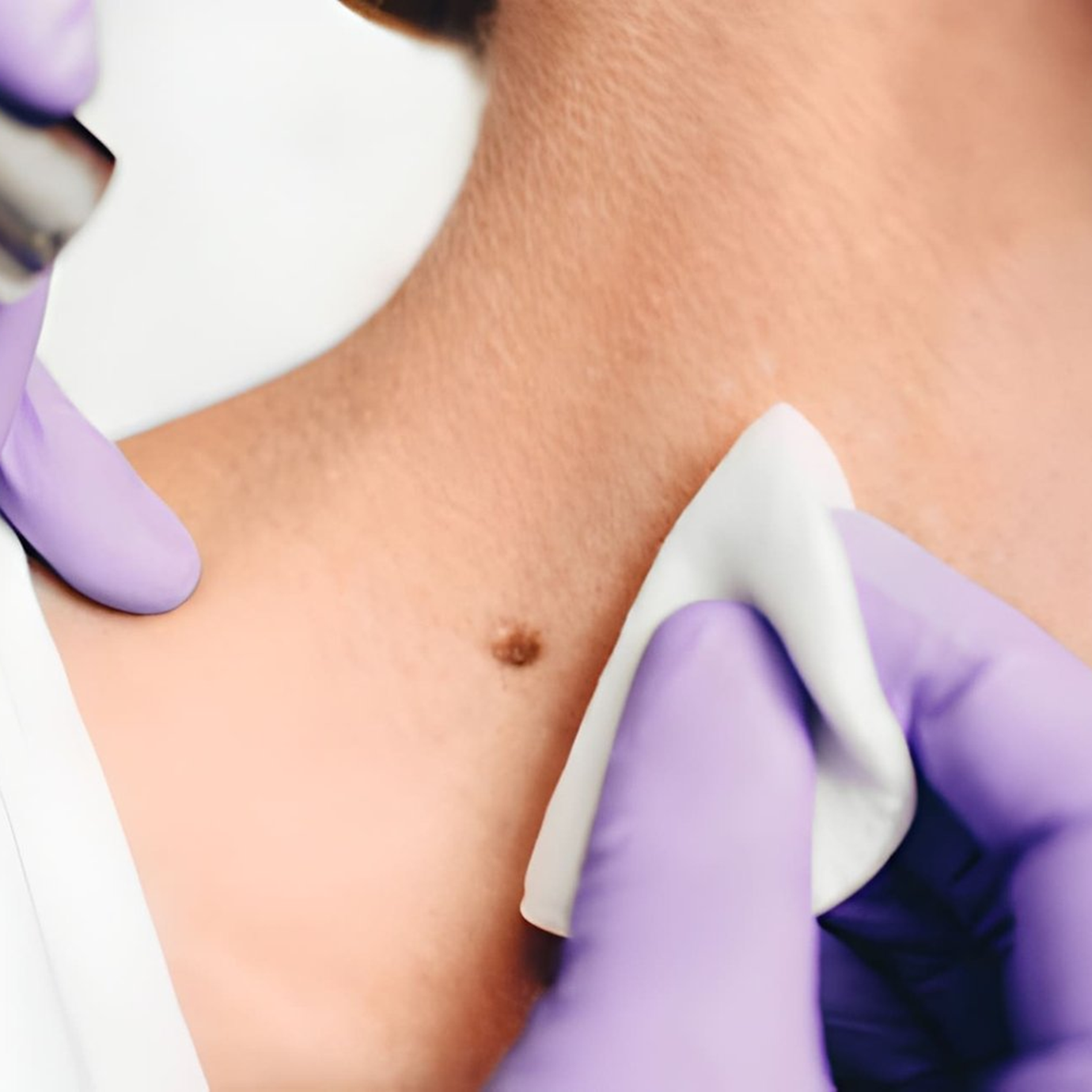 Mole Removal 1