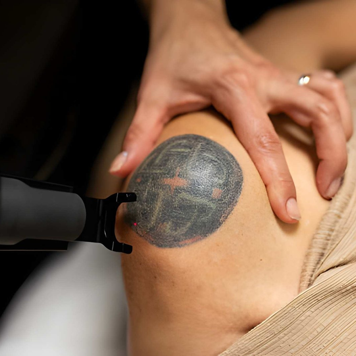 Tattoo Removal 1